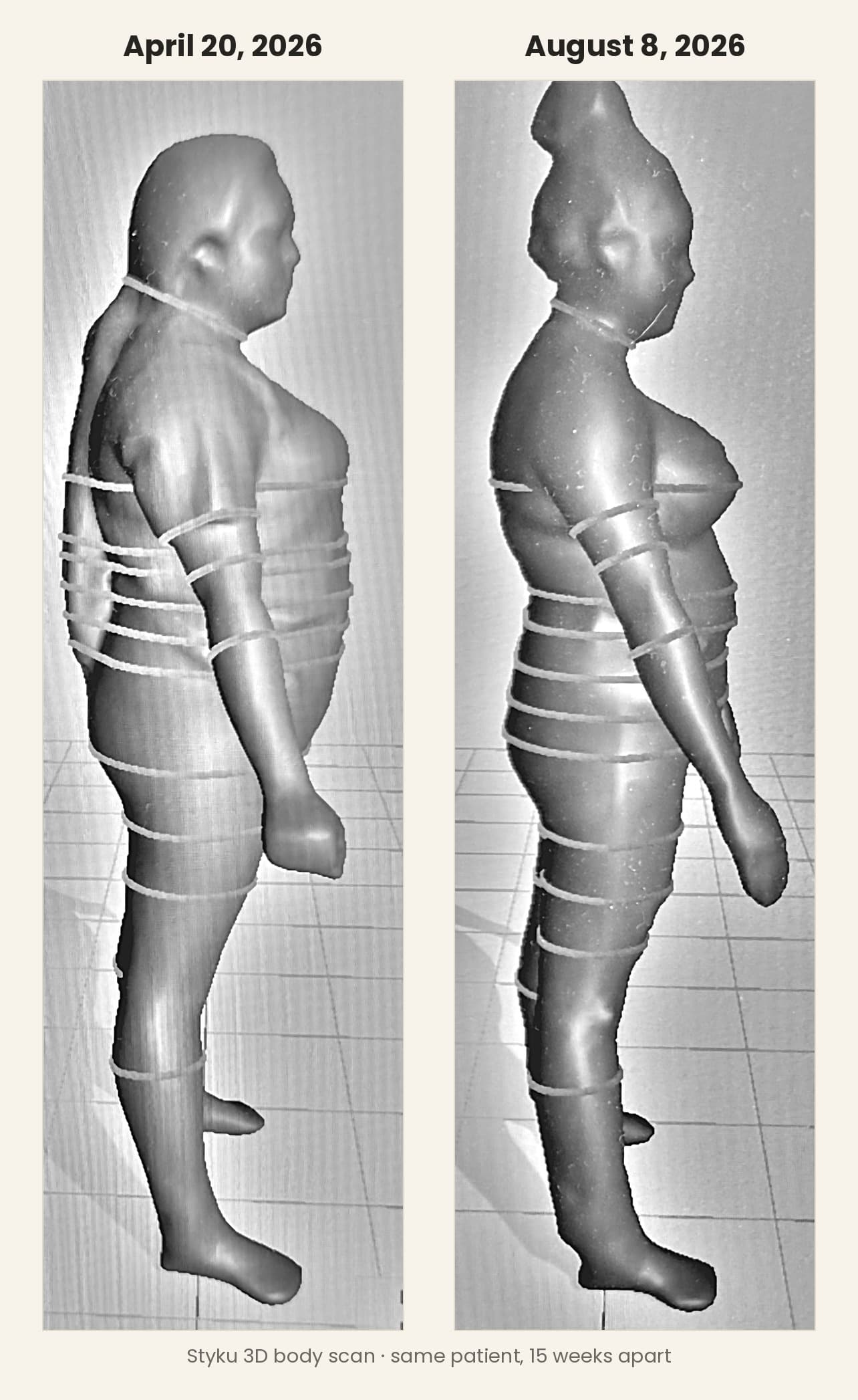 Two Styku 3D body scans of the same patient shown side by side, dated 20 April 2026 and 8 August 2026, with the later scan noticeably slimmer through the midsection.